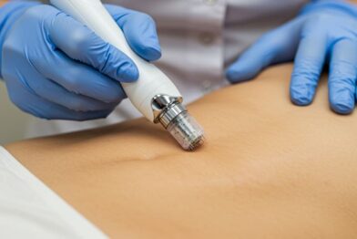 Tratamento para Estrias (com ácidos, laser ou microagulhamento)